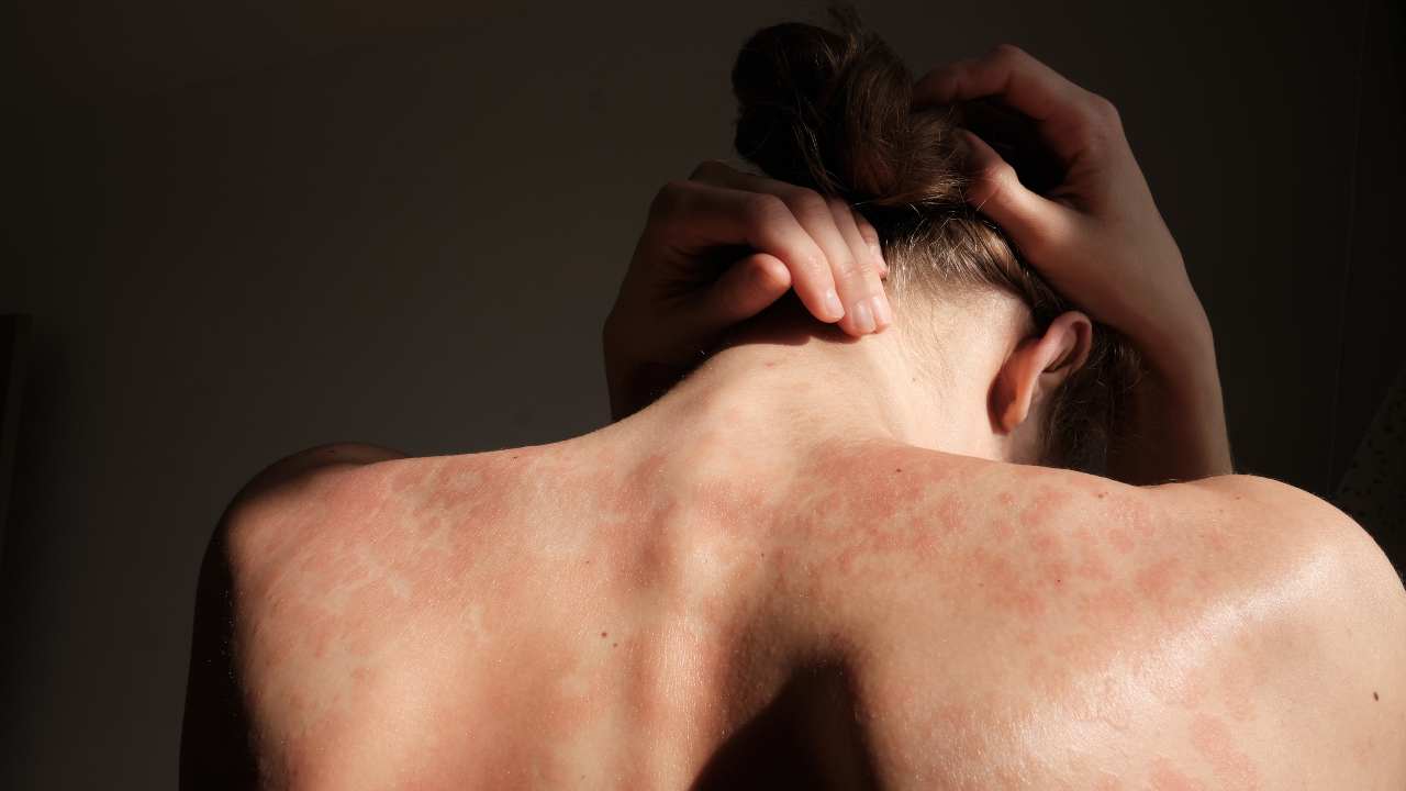 Le terribili conseguenze della psoriasi sul corpo. - Improntaunika.it